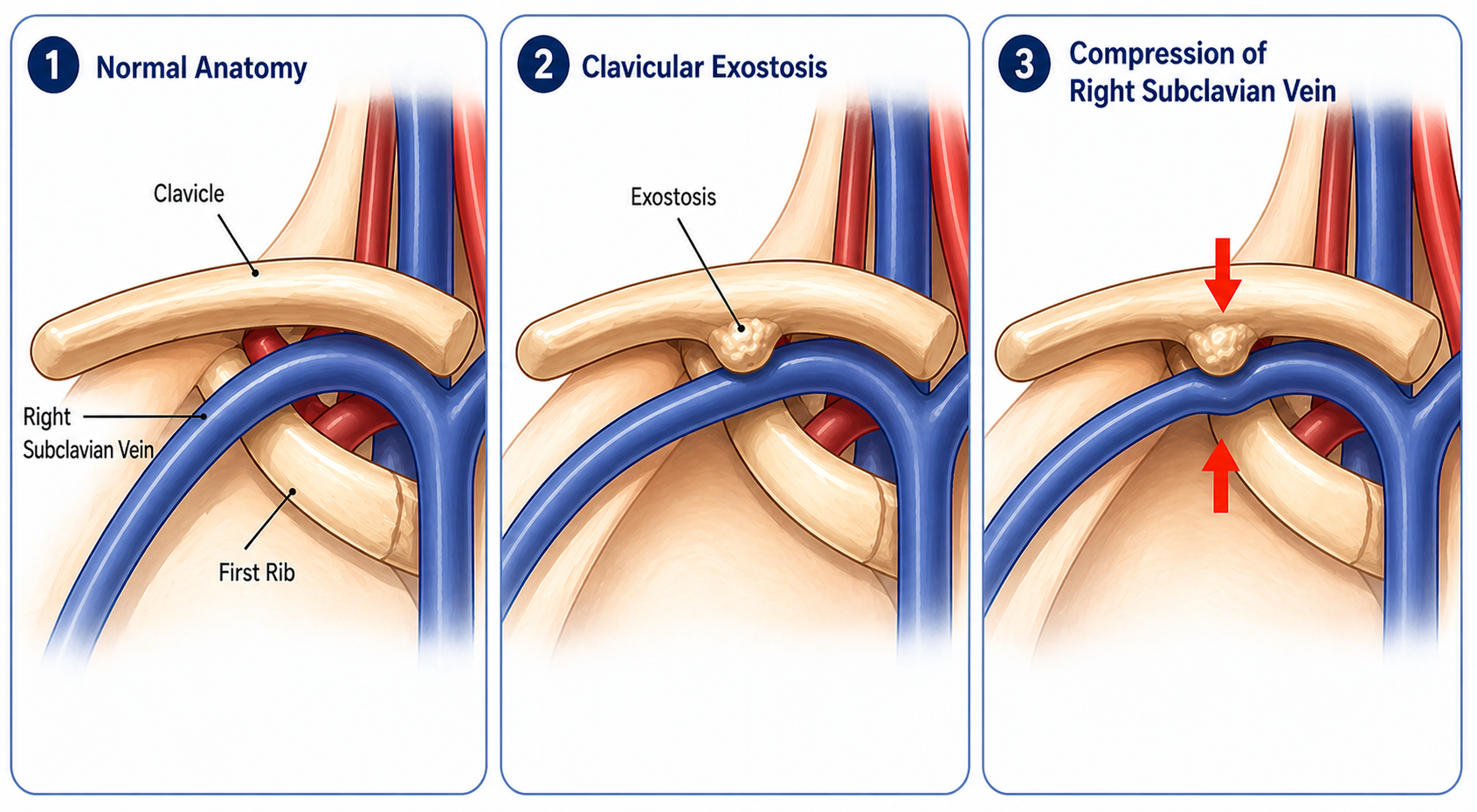 Rare bone growth compressing major vein successfully treated at Manipal Hospital Baner through complex multidisciplinary surgery